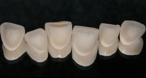 Blanqueamiento dental 