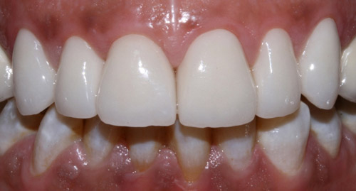 Blanqueamiento dental