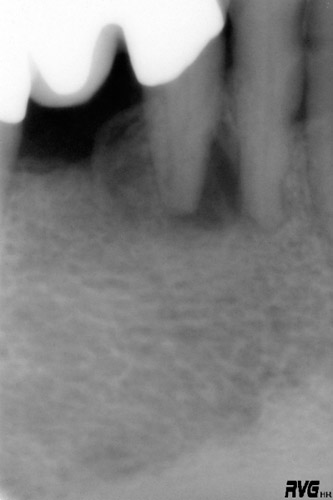 Endodoncia en Alicante