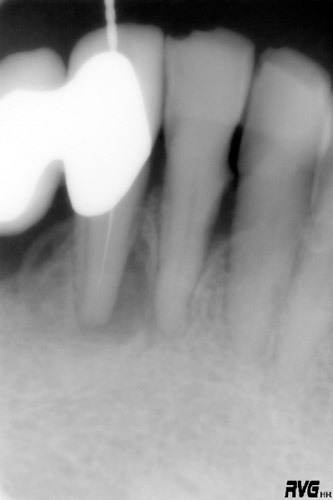 Endodoncia en Alicante