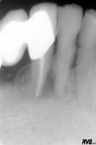 Endodoncia en Alicante