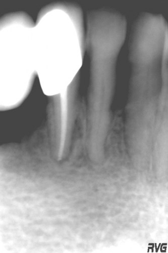 Endodoncia en Alicante