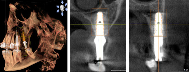 Implantes dentales