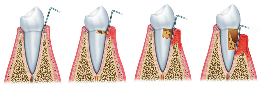 Tratamiento periodontal