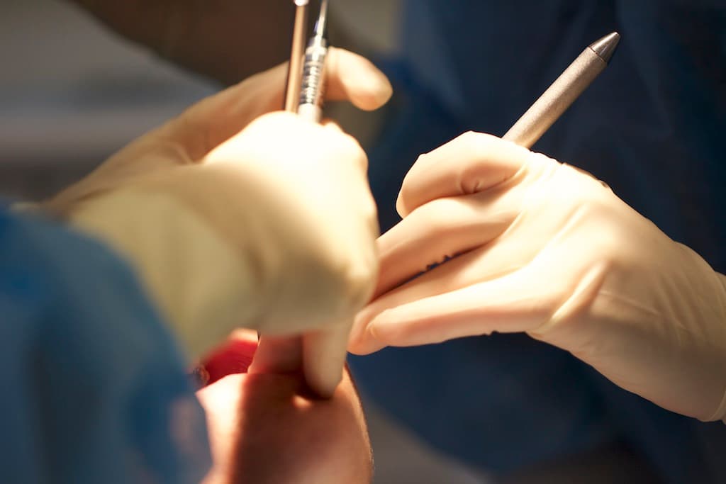 colocacion de implantes