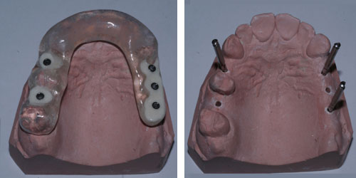 implantes dentales 1