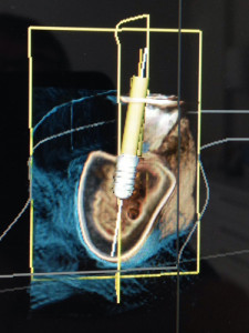 Implantes dentales en Alicante