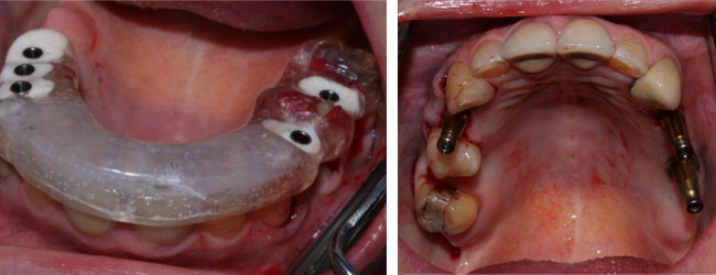 implantes dentales en Alicante