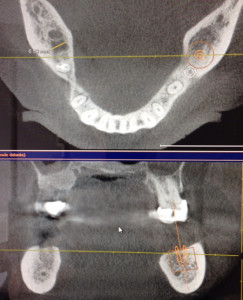 Implantes dentales en Alicante